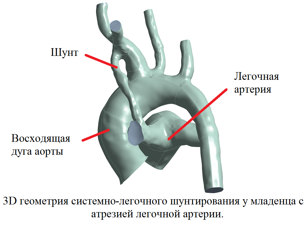 МОДЕЛИРОВАНИЕ ГЕМОДИНАМИКИ ДЛЯ ПЛАНИРОВАНИЯ ХИРУРГИЧЕСКИХ ВМЕШАТЕЛЬСТВ ПРИ ВРОЖДЕННОЙ ПАТОЛОГИИ ЛЕГОЧНОГО КРОВОТОКА У ДЕТЕЙ
